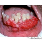 18. An Overview of Oral Cancer.jpg