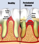 20. How Mild Gum Disease turns into Periodontal Disease.jpg